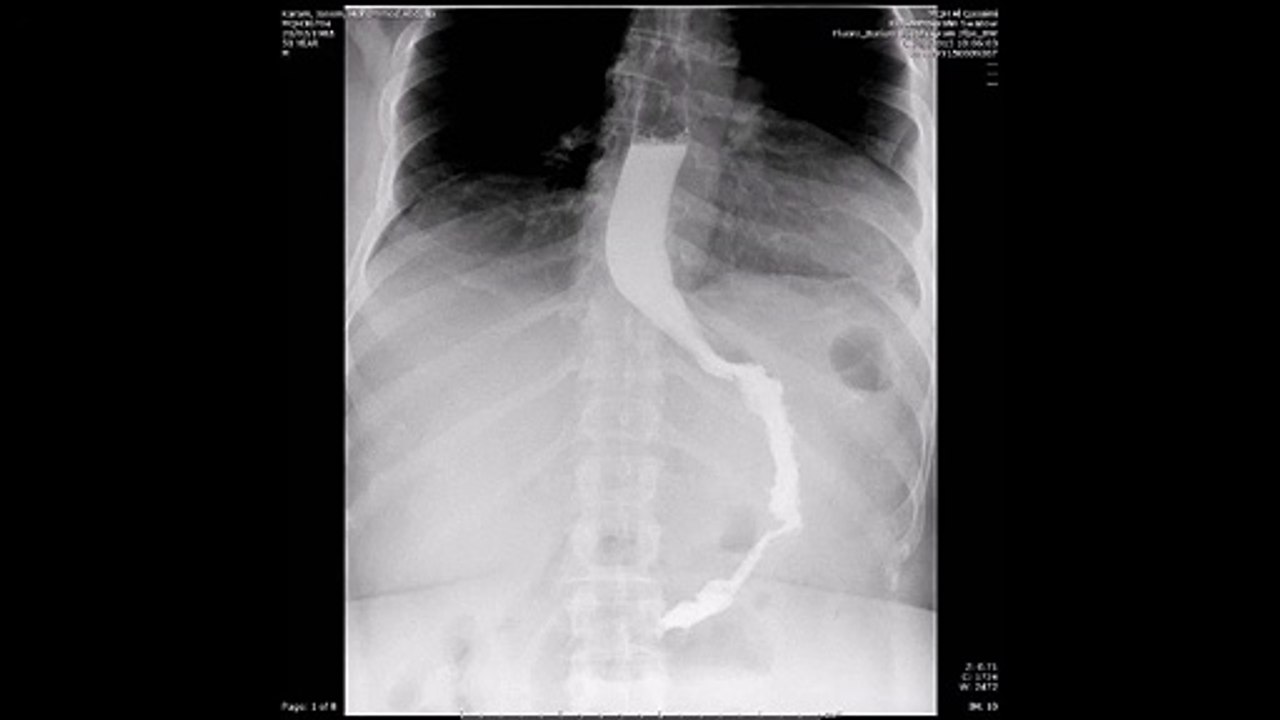 SASI bypass gastrograffin