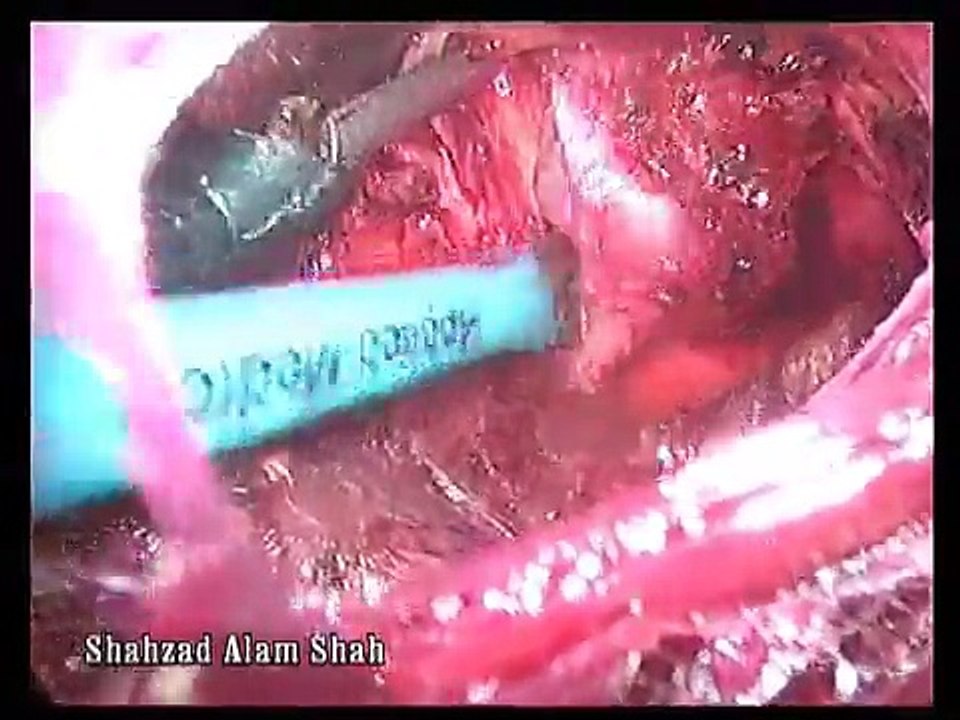 ENDOSCOPIC ENUCLEATION OF FIBROADENOMA BREAST