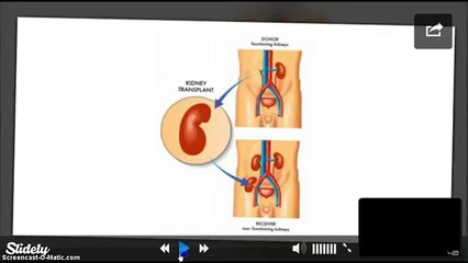 Kidney Transplant Surgery in India