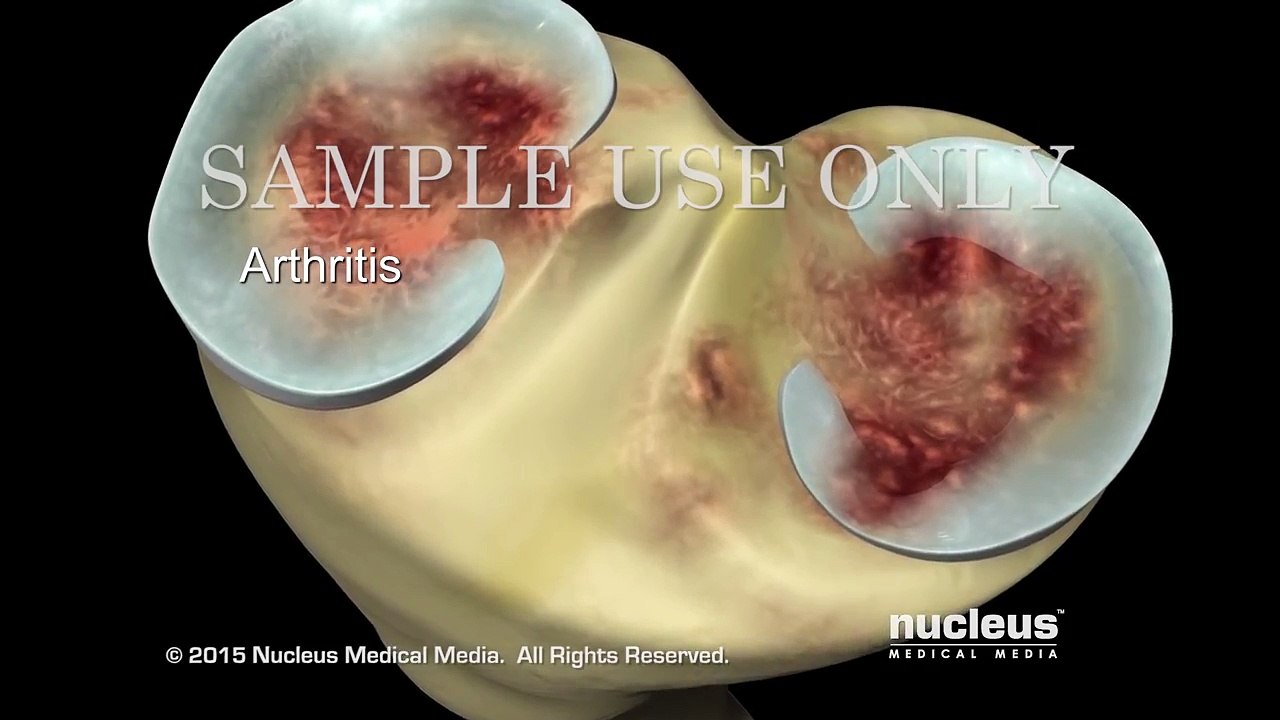 Total Knee Joint Replacement Surgery