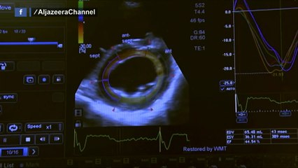 أبحاث لفهم اضطرابات نبضات القلب والدورة الدموية لدى الأطفال