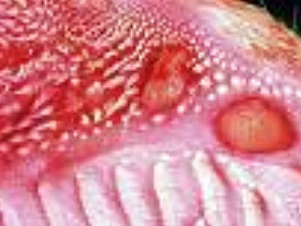 polisitemi_tedavisi,polisitemi hastalıkları,polisitemi hastalığı tedavisi,polisitemi nedenleri polisitemi tedavisi,polisitemi nedenleri,polisitemi nedir,polisitemi tedavisi varmı,polisitemi polisitemia vera