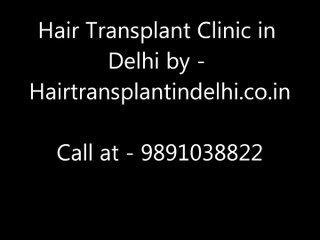Hair Transplant in Delhi by Dr Sangay Bhutia