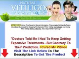 Natural Vitiligo Treatment System Review & Bonus WATCH FIRST Bonus + Discount