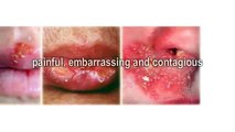 how can i get rid of cold sores fast