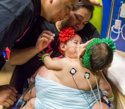 Mira los impactantes resultados de cirugía que separó a siamesas unidas por tórax