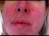 Imagenes de acne rosacea, rosacea