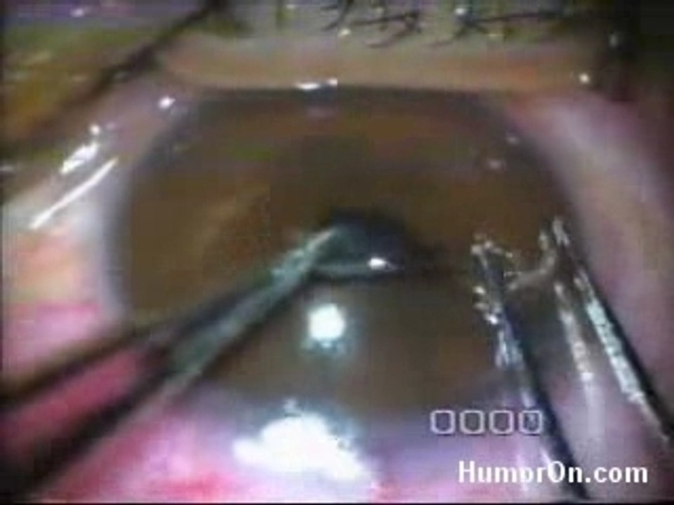 Eye_worm_removal