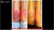 How To Get Rid Of Hives - Remedies For Allieviating Chronic Idiopathic Urticaria - How To Get Rid Of
