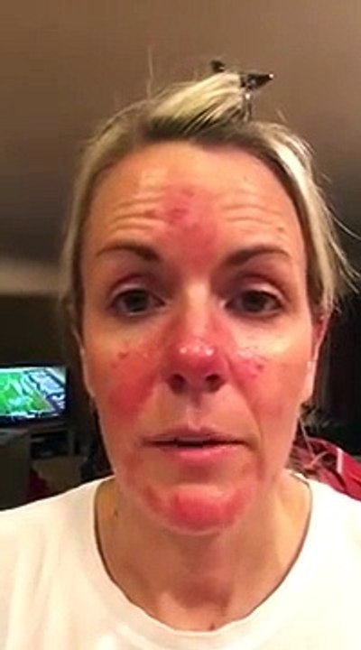 Rosacea - demised mites