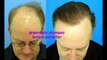 Hair Loss in Women,female pattern Hair Loss,female Hair Loss Treatment,Scalp Treatment,Hair Regrowth