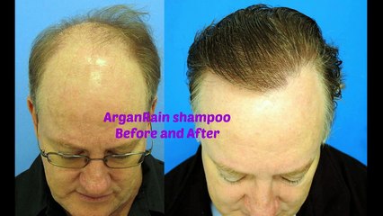 Download Video: Hair Loss in Women,female pattern Hair Loss,female Hair Loss Treatment,Scalp Treatment,Hair Regrowth