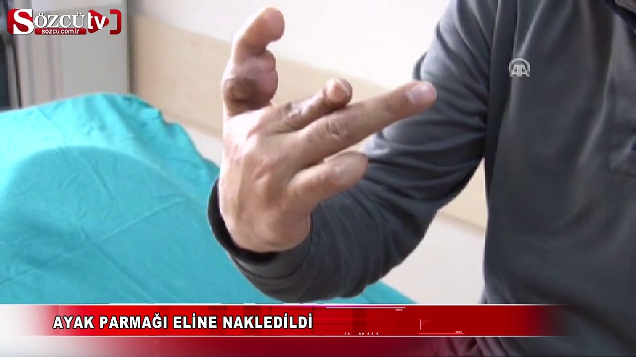 Ayak parmağı eline nakledildi