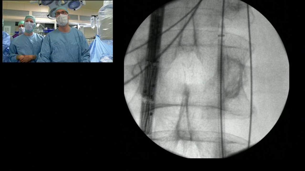 FENESTRATED AORTIC ENDOGRAFT + OPEN CHIMNEY TECHNIC