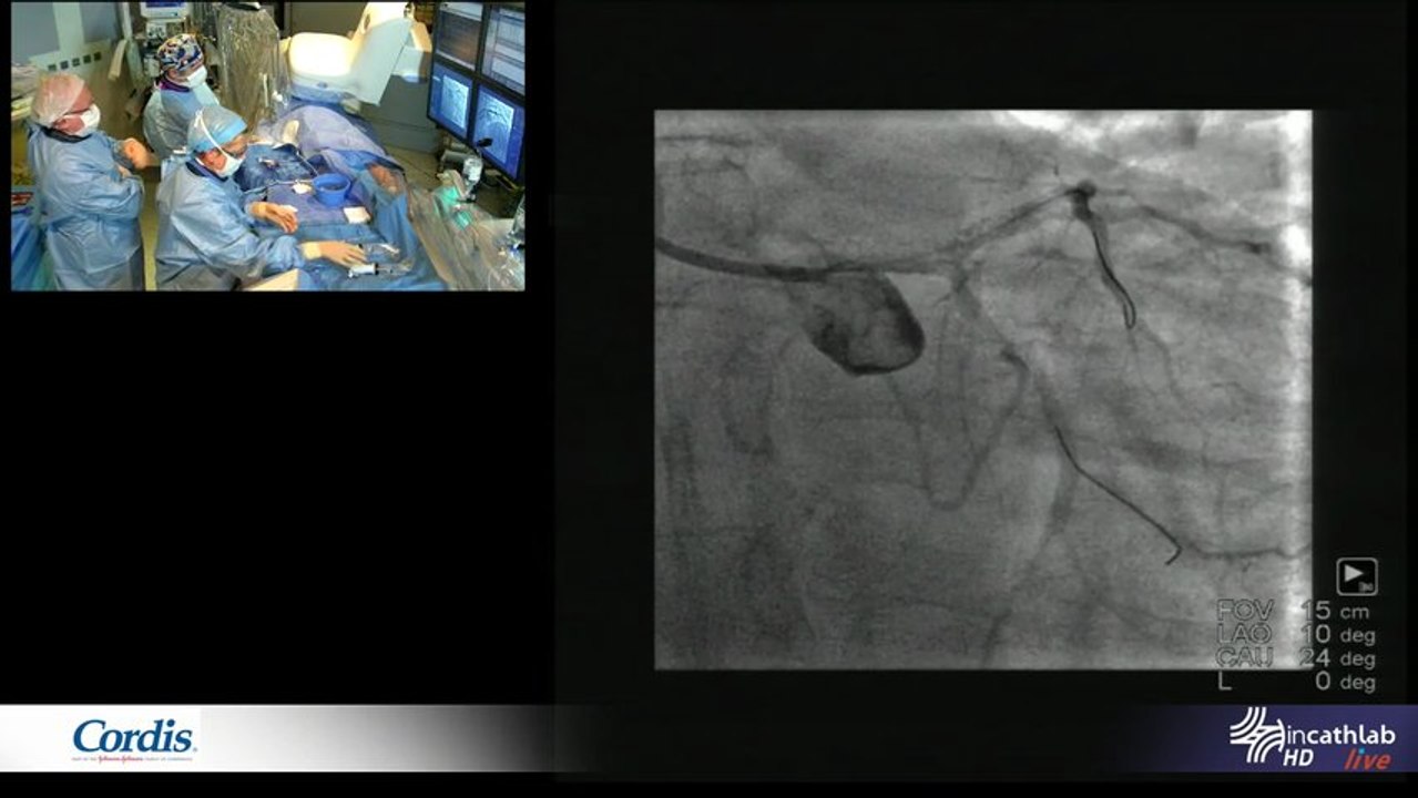 Right radial approach for left main PCI