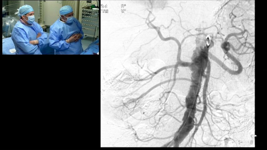Complex Right renal artery stenosis femoral approach for renal artery stenting.Left Renal artery occlusion