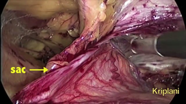 Laparoscopic TAPP Inguinal (groin) Hernia Repair : The Indirect Sac