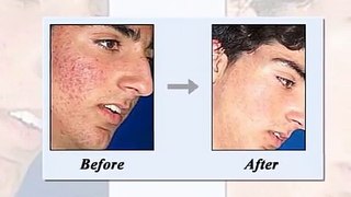 Acne No More Review - Cure Acne Holistically