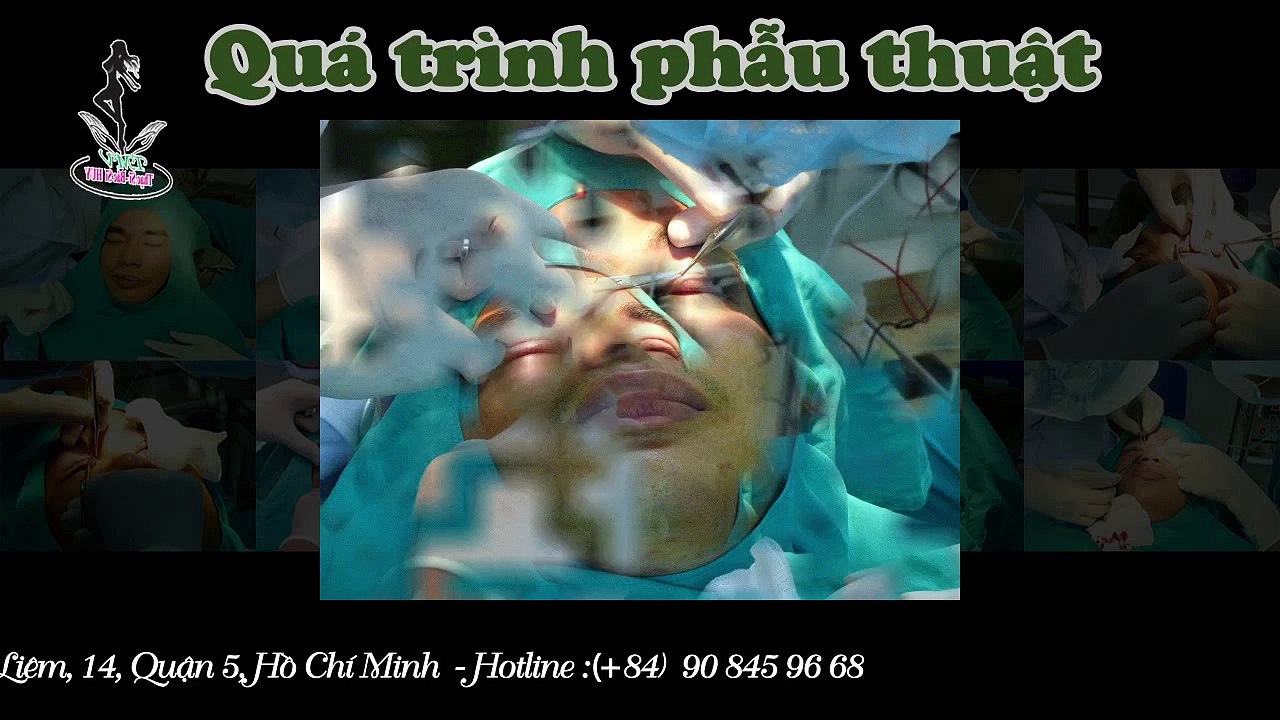 Bấm mí mắt Hàn Quốc đẹp tự nhiên, vĩnh viễn an toàn tại thammyviensaigonvenus.vn
