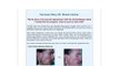 Acne no more reviews,best remedy for acne,treatment for adult acne