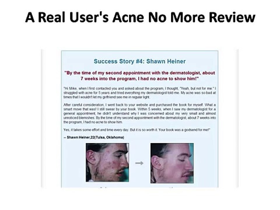Acne no more reviews,best remedy for acne,treatment for adult acne