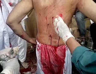 Zakir Attash Abbas Having Stitchis After Zanjeer Zani