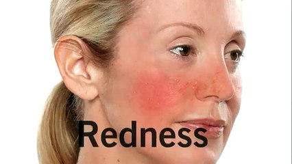 Reduce Redness & Irritation - Rosacea Treatment - Rodan and Fields - Soothe (skinproductsdirect.com)