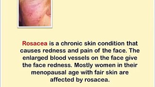 How To Remedy Rosacea - Rosacea Tips