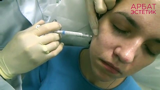 Радиесс (Radiesse) контурная пластика. До и после.