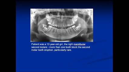 A Rare Case More Than One Tooth Block the Second Molar Tooth Eruption