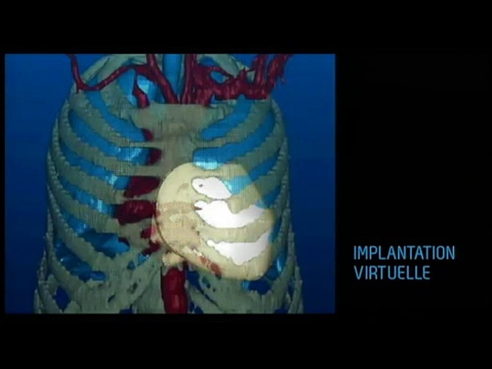 Un coeur artificiel et définitif