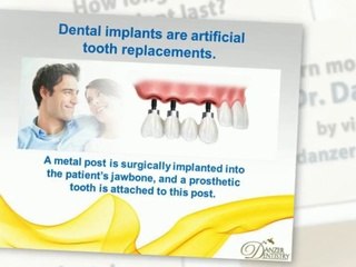 Dental Implants Westminster - Danzer Dentistry - 303 255-3880