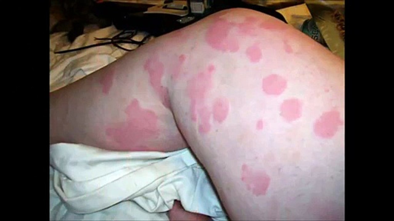 urticaria treatment home remedies for hives - how to get rid of hives - natural cure for hives