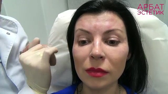 Ботокс- часто задаваемые вопросы. Врач-косметолог Чахоян Левон Робертович.