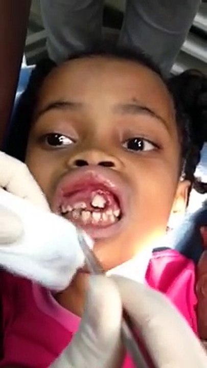 Une fille de 10 ans les gencives infestées de larves