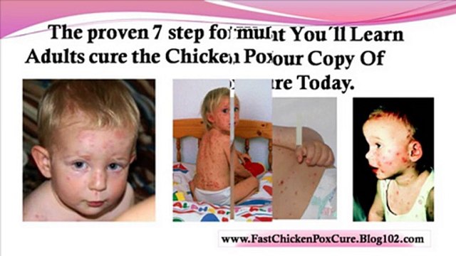 chicken pox treatment for children - chicken pox symptoms in adults - chicken pox contagious period
