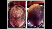 Best Hair loss treatment | How to stop hair loss naturally and baldness cure 2015