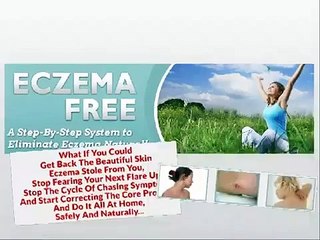 Home remedy for eczema - Beat eczema