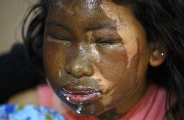 Genç, Yolda Yürüyen Kızların Yüzünü Kezzapla Yaktı!