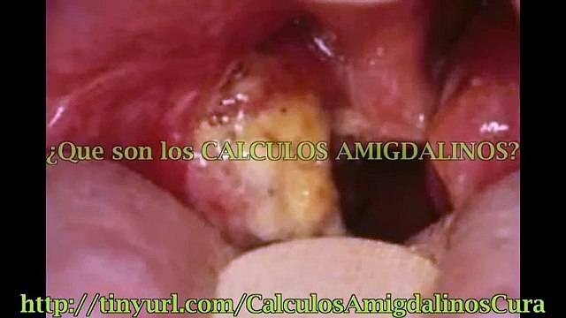 Calculos Amigdalinos Cura, Tratamiento, Remedio Natural