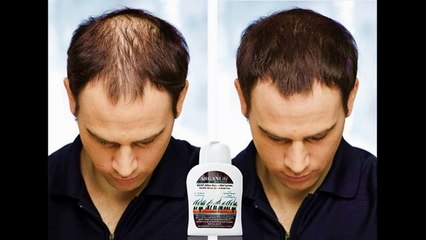 POSIBLE CURE FOR BALDNESS REVIEW ARGAN LIFE REVIEWS Argan Life !