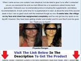 Don't Buy Natural Vitiligo Treatment System Natural Vitiligo Treatment System Review Bonus   Discoun
