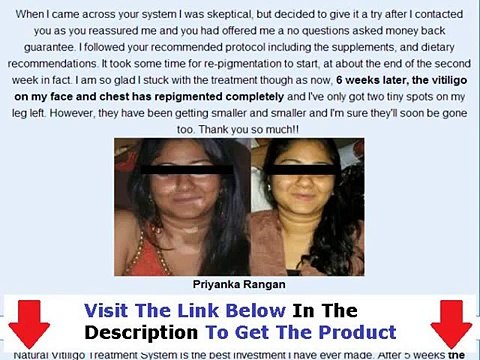 Don't Buy Natural Vitiligo Treatment System Natural Vitiligo Treatment System Review Bonus + Discoun