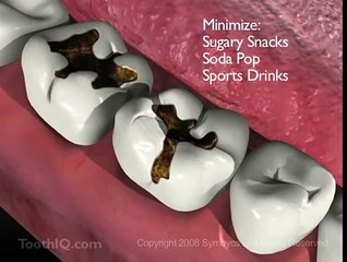 Diş Çürümesi - Smiles312 - Ankara Diş Kliniği