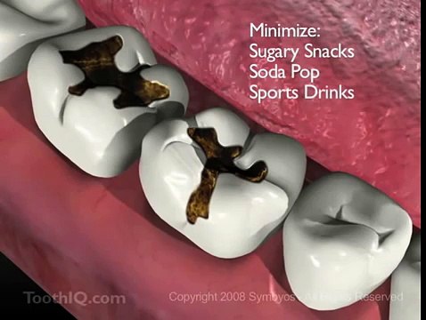Diş Çürümesi - Smiles312 - Ankara Diş Kliniği