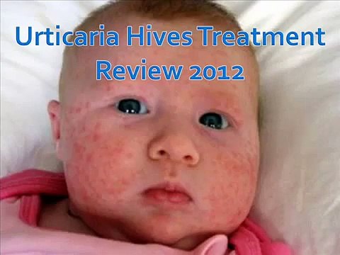 urticaria treatment I Found a Special Discount for Natural Urticaria Relief (no review)