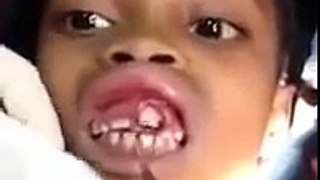 Dentists Removes Maggots From Little Girl's Gums