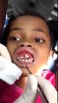 Dentists Removes Maggots From Little Girl's Gums