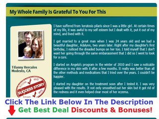 Keratosis Pilaris Treatment Cetaphil + Must Watch!!