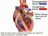 Heart valve surgery - operation for replacement heart valves
